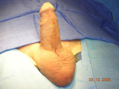 Penis Inplant 87