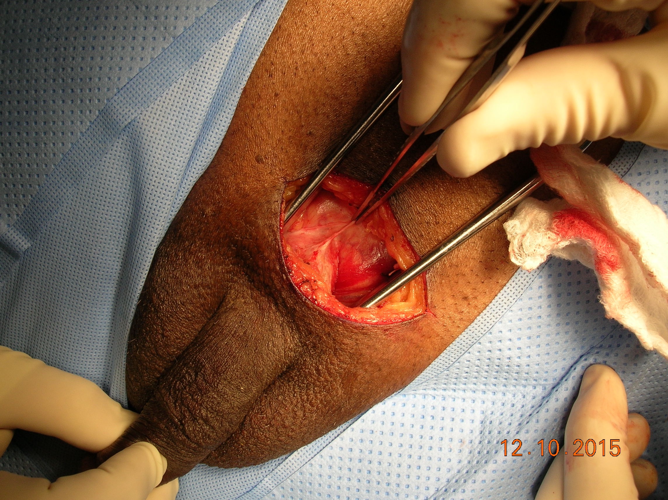 Male Penis Enlargement Surgery 59