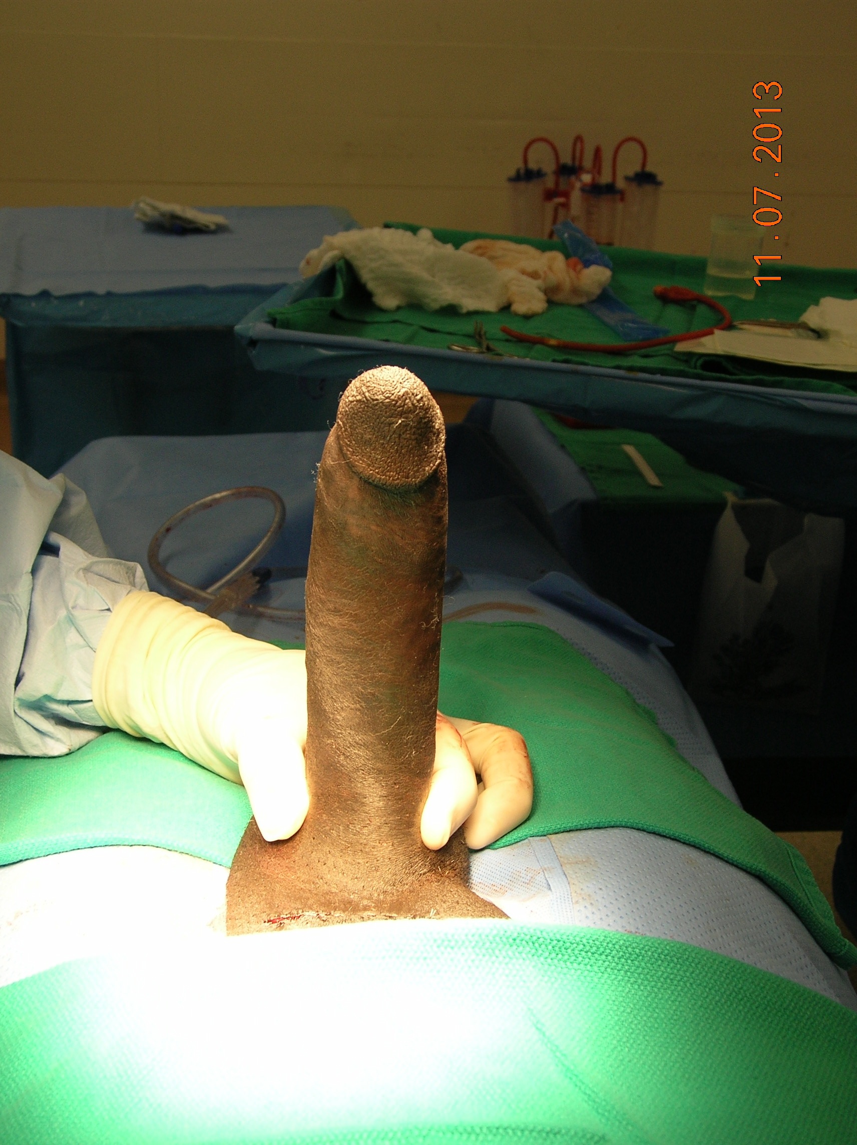 Larger Penis Surgery 111