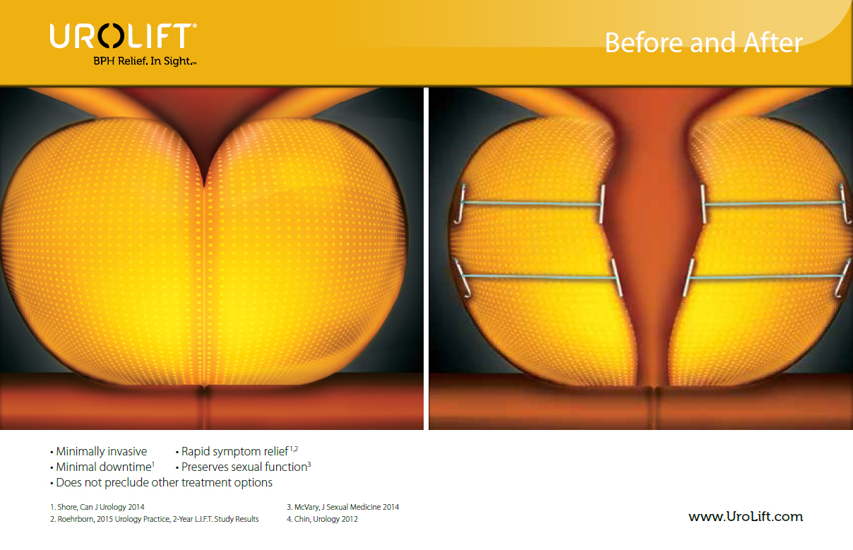 prima e dopo intervento di chirurgia prostatica mininvasiva con Urolift