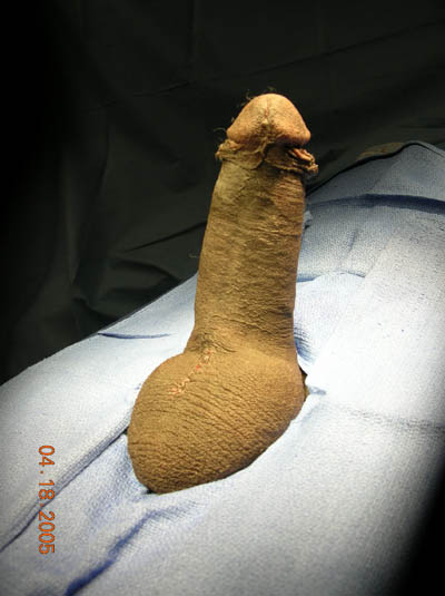Impotence Penile Implant Example 1