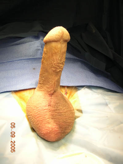 Impotence Penile Implant Example 3