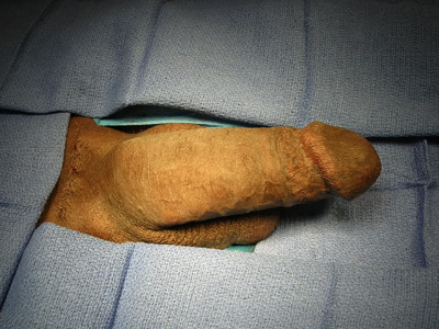 Impotence Penile Implant Example 5a