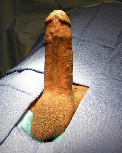 Impotence Penile Implant Example 5b