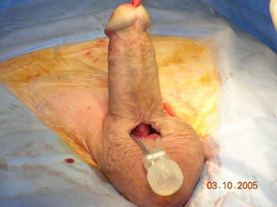 Penile Implant Surgery Figure 10