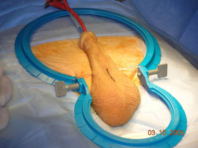 Penile Implant Surgery Figure 2