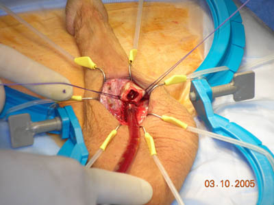 Penile Implant Surgery Figure 4