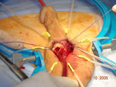 Penile Implant Surgery Figure 5