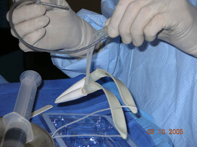 Penile Implant Surgery Figure 6